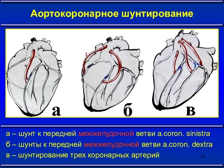 Аортокоронарное шунтирование а – шунт к передней межжелудочной ветви a.coron. sinistra