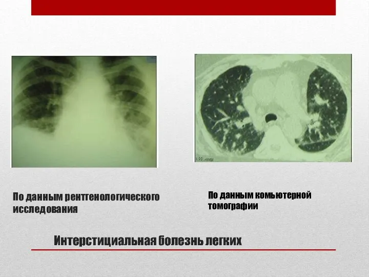 По данным рентгенологического исследования По данным комьютерной томографии