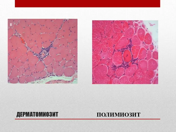 ДЕРМАТОМИОЗИТ ПОЛИМИОЗИТ