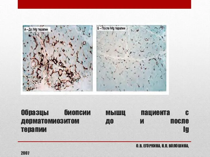 Образцы биопсии мышц пациента с дерматомиозитом до и после терапии Ig О.В. ЕГОРКИНА, Н.П. ВОЛОШИНА, 2007