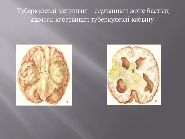 Туберкулезді менингит – жұлынның және бастың жұмсақ қабатының туберкулезді қабыну.