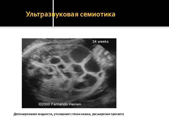 Ультразвуковая семиотика Депонироавние жидкости, утолщение стенки кишки, расширение просвета