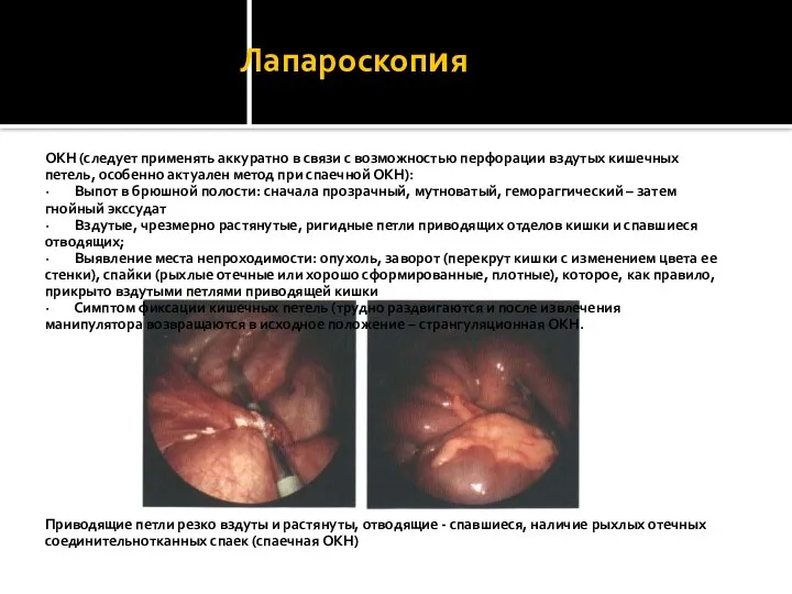 Лапароскопия ОКН (следует применять аккуратно в связи с возможностью перфорации вздутых