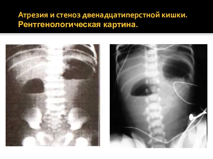 Атрезия и стеноз двенадцатиперстной кишки. Рентгенологическая картина.