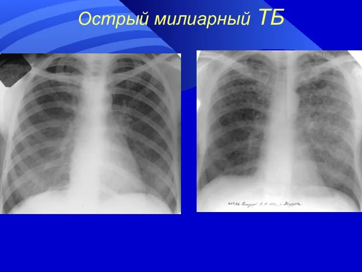 Острый милиарный ТБ