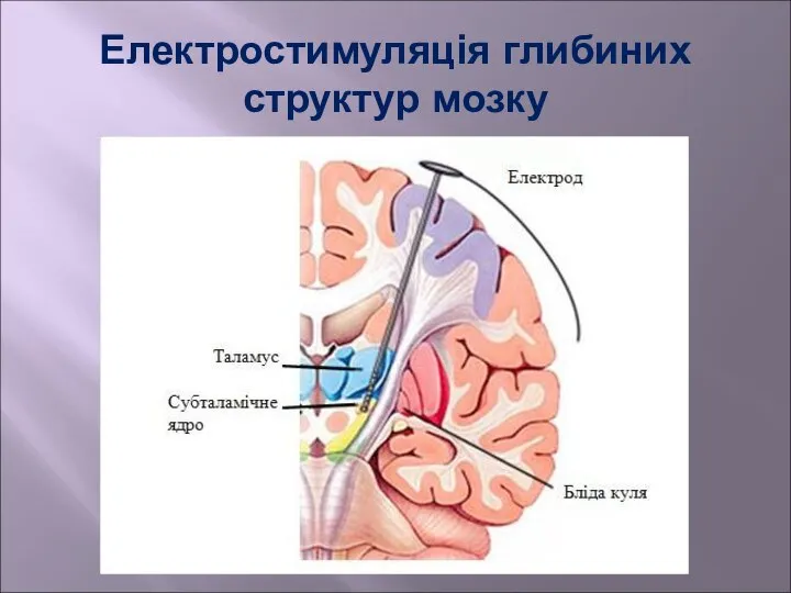 Електростимуляція глибиних структур мозку