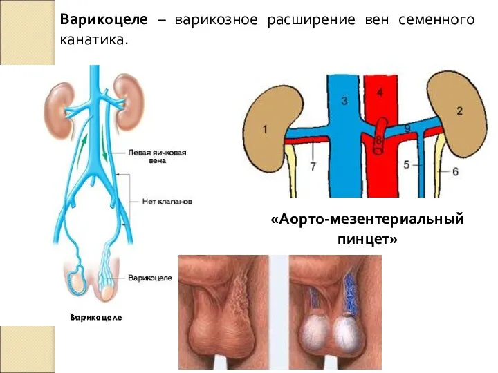 Варикоцеле – варикозное расширение вен семенного канатика. «Аорто-мезентериальный пинцет»