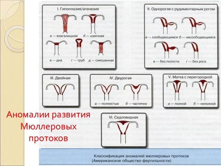 Аномалии развития Мюллеровых протоков