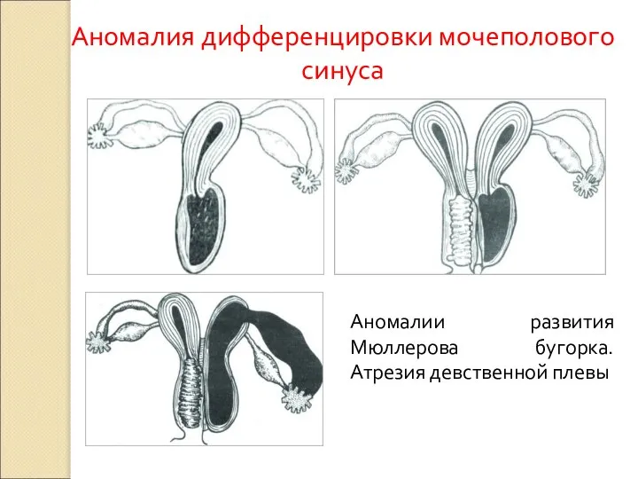 Аномалия дифференцировки мочеполового синуса Аномалии развития Мюллерова бугорка. Атрезия девственной плевы