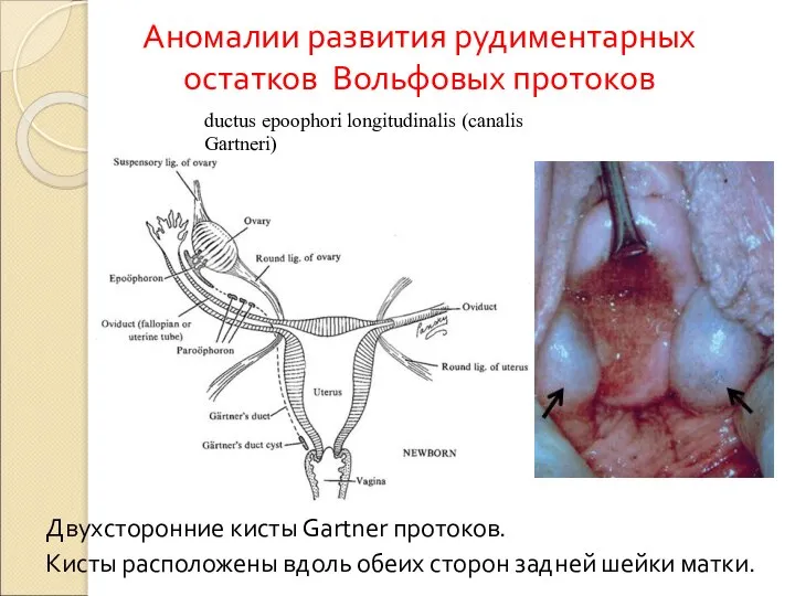 Аномалии развития рудиментарных остатков Вольфовых протоков ductus epoophori longitudinalis (canalis Gartneri)