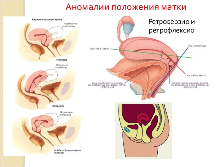 Аномалии положения матки Ретроверзио и ретрофлексио