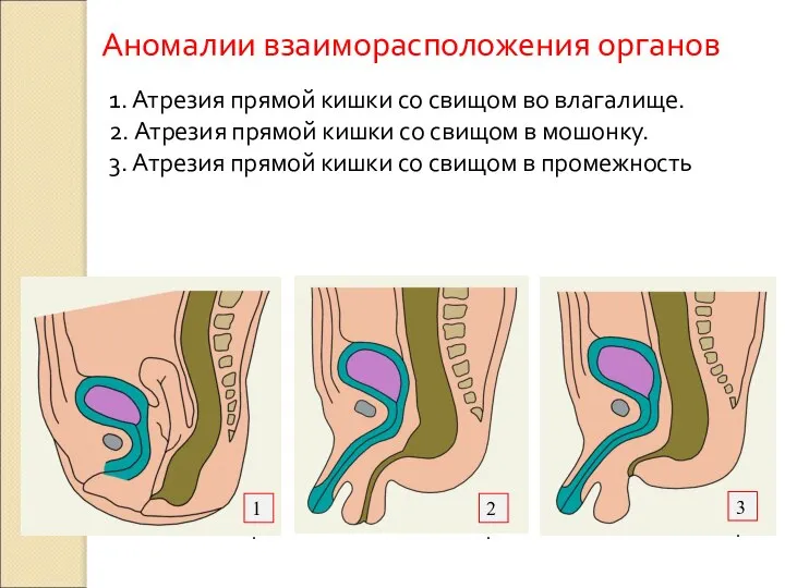 Аномалии взаиморасположения органов 1. Атрезия прямой кишки со свищом во влагалище.