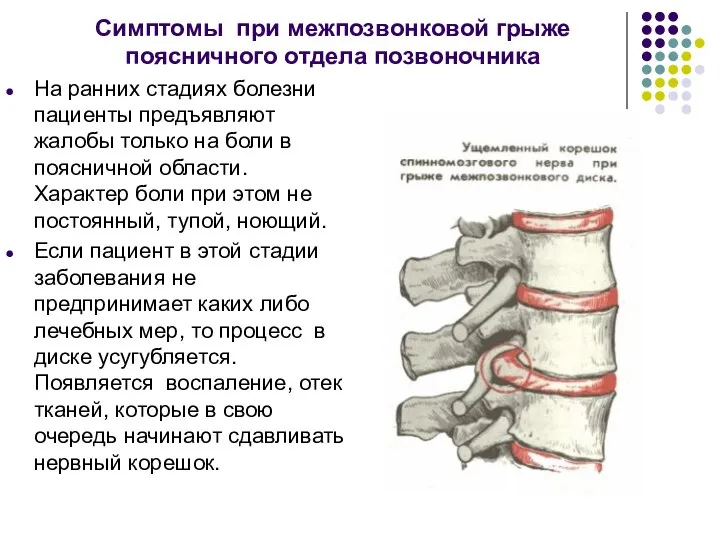 Симптомы при межпозвонковой грыже поясничного отдела позвоночника На ранних стадиях болезни