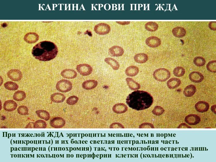 КАРТИНА КРОВИ ПРИ ЖДА При тяжелой ЖДА эритроциты меньше, чем в