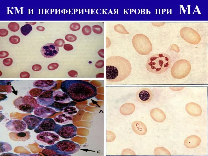 КМ И ПЕРИФЕРИЧЕСКАЯ КРОВЬ ПРИ МА