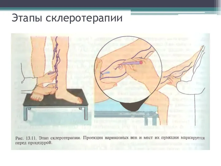 Этапы склеротерапии