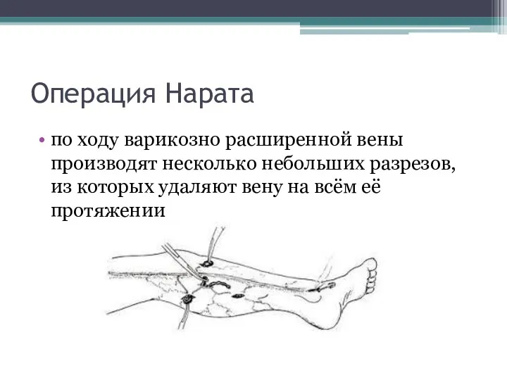 Операция Нарата по ходу варикозно расширенной вены производят несколько небольших разрезов,