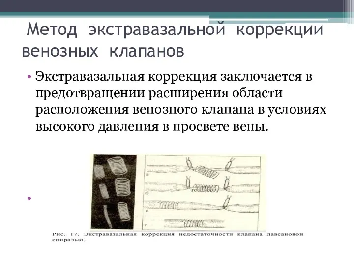 Метод экстравазальной коррекции венозных клапанов Экстравазальная коррекция заключается в предотвращении расширения