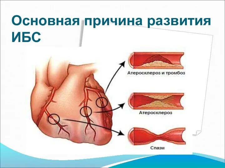 Основная причина развития ИБС