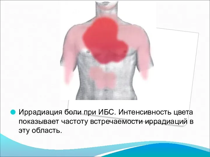 Иррадиация боли при ИБС. Интенсивность цвета показывает частоту встречаемости иррадиаций в эту область.