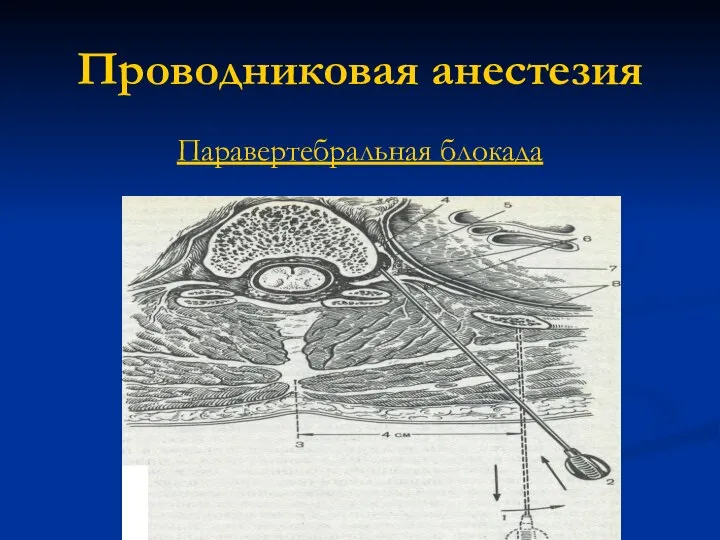 Проводниковая анестезия Паравертебральная блокада