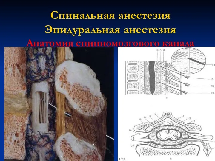 Спинальная анестезия Эпидуральная анестезия Анатомия спинномозгового канала