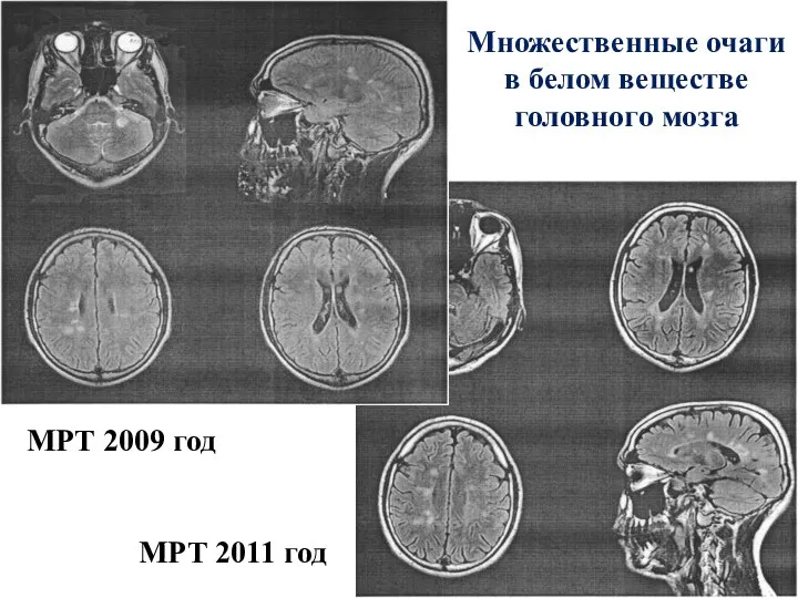 Множественные очаги в белом веществе головного мозга МРТ 2009 год МРТ 2011 год