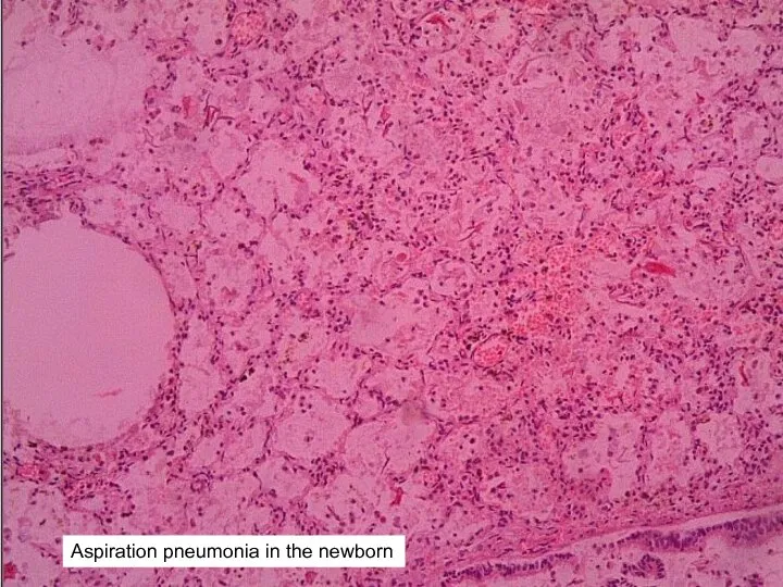 Aspiration pneumonia in the newborn