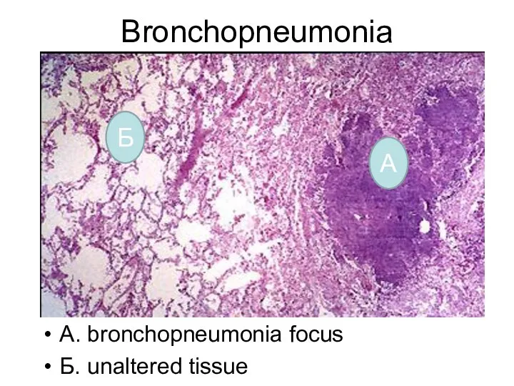 Bronchopneumonia А. bronchopneumonia focus Б. unaltered tissue Б А