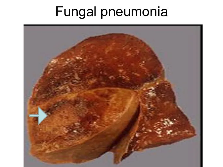 Fungal pneumonia