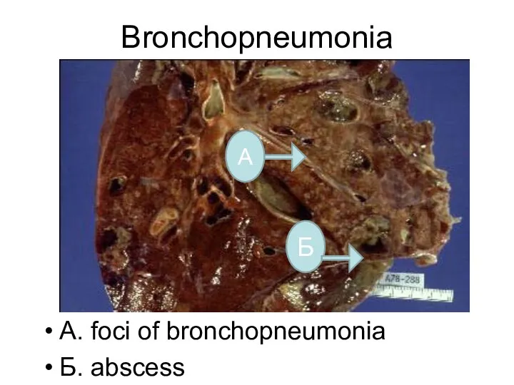 Bronchopneumonia А. foci of bronchopneumonia Б. abscess А Б