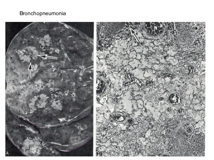 Bronchopneumonia