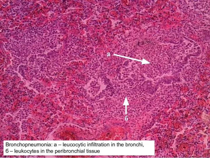 Bronchopneumonia: а – leucocytic infiltration in the bronchi, б – leukocytes