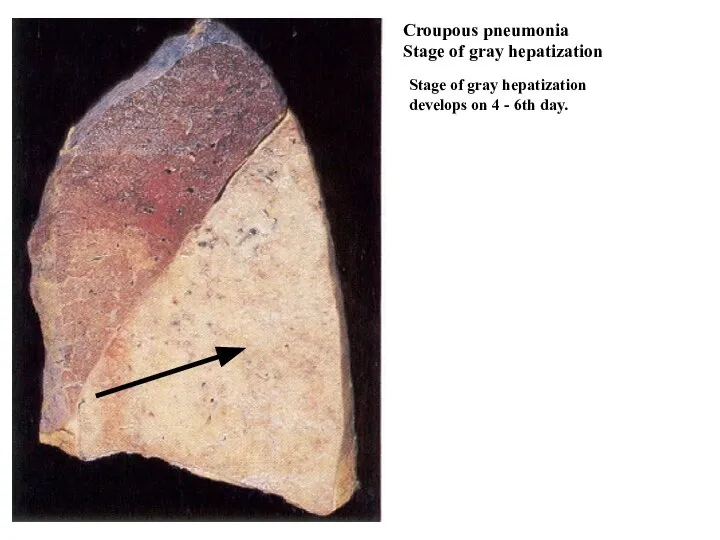 Croupous pneumonia Stage of gray hepatization Stage of gray hepatization develops on 4 - 6th day.