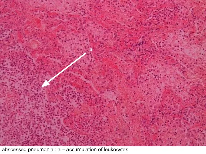 abscessed pneumonia : а – accumulation of leukocytes а