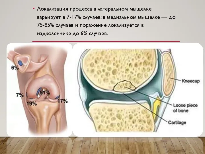 Локализация процесса в латеральном мыщелке варьирует в 7-17% случаев; в медиальном