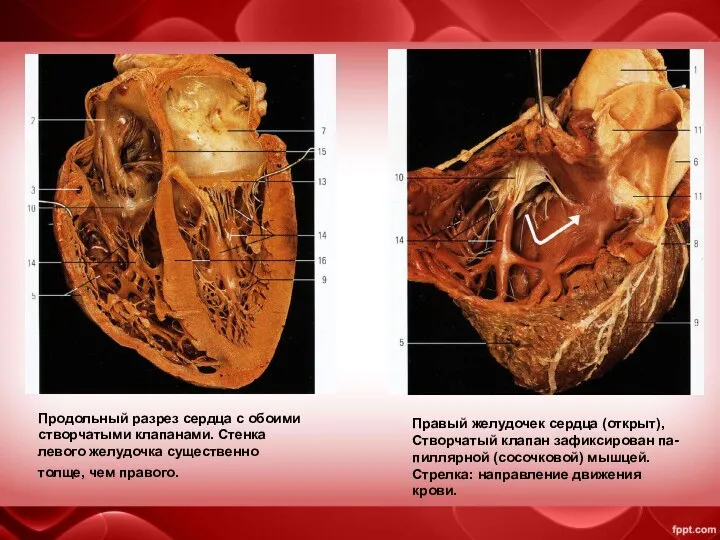 Продольный разрез сердца с обоими створчатыми клапанами. Стенка левого желудочка существенно