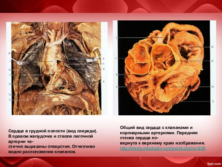 Сердце в грудной полости (вид спереди).В правом желудочке и стволе легочной