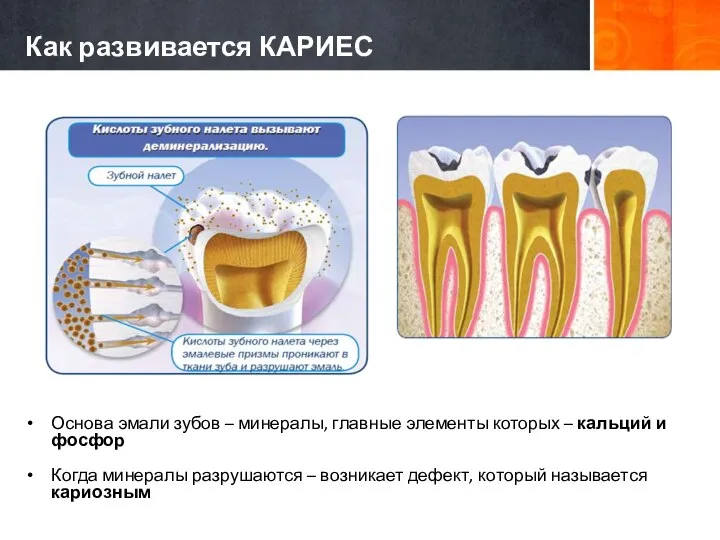 Как развивается КАРИЕС Основа эмали зубов – минералы, главные элементы которых