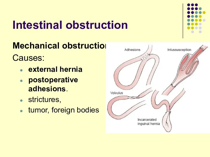 Intestinal obstruction Mechanical obstruction Causes: external hernia postoperative adhesions. strictures, tumor, foreign bodies