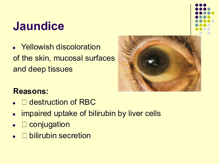 Jaundice Yellowish discoloration of the skin, mucosal surfaces and deep tissues