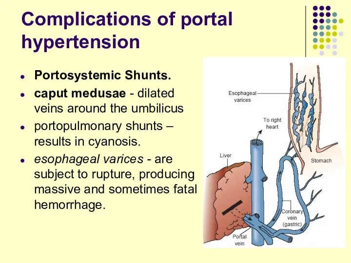 Complications of portal hypertension Portosystemic Shunts. caput medusae - dilated veins