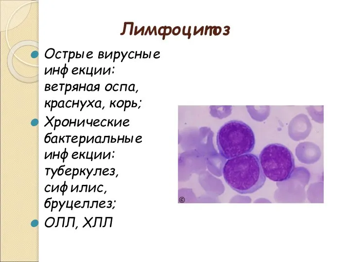 Лимфоцитоз Острые вирусные инфекции: ветряная оспа, краснуха, корь; Хронические бактериальные инфекции: туберкулез, сифилис, бруцеллез; ОЛЛ, ХЛЛ