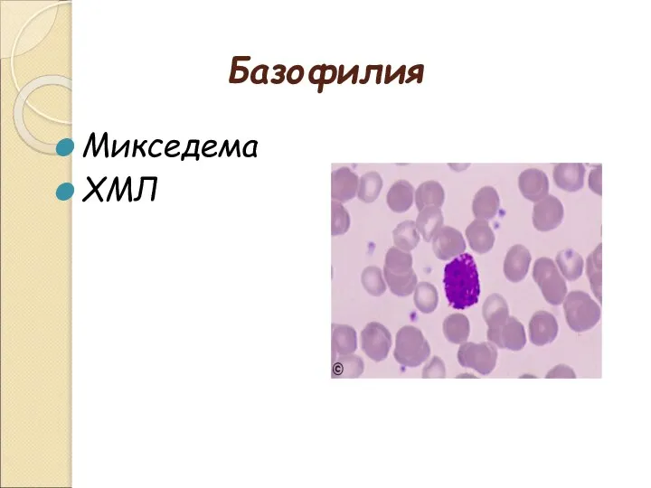 Базофилия Микседема ХМЛ