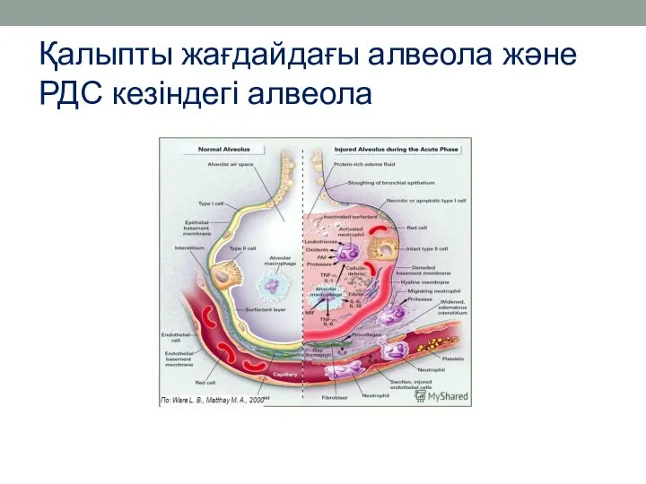 Қалыпты жағдайдағы алвеола және РДС кезіндегі алвеола