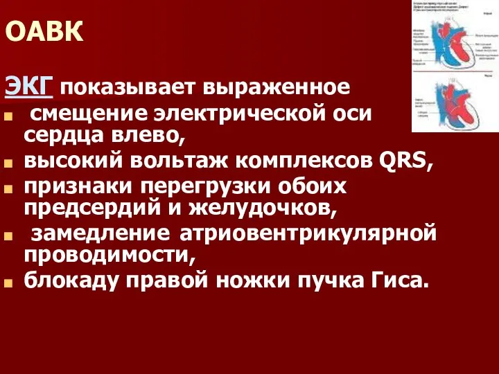 ОАВК ЭКГ показывает выраженное смещение электрической оси сердца влево, высокий вольтаж