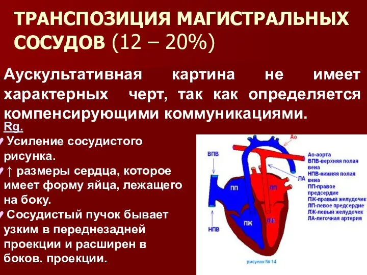 ТРАНСПОЗИЦИЯ МАГИСТРАЛЬНЫХ СОСУДОВ (12 – 20%) Аускультативная картина не имеет характерных