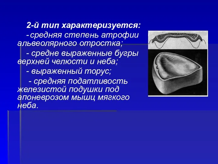 2-й тип характеризуется: - средняя степень атрофии альвеолярного отростка; - средне