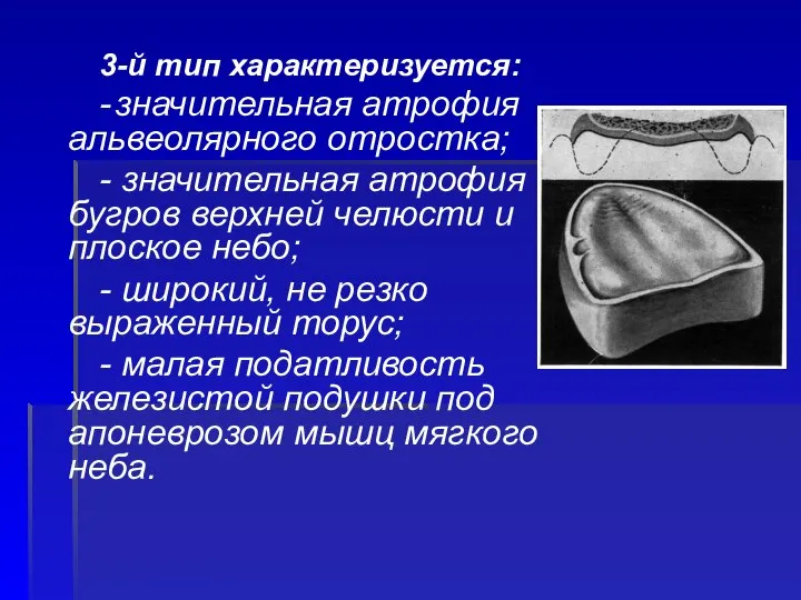 3-й тип характеризуется: - значительная атрофия альвеолярного отростка; - значительная атрофия