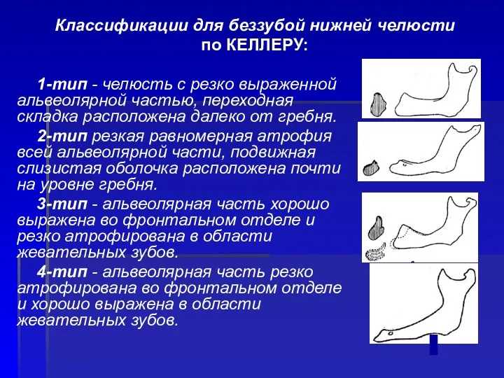 1-тип - челюсть с резко выраженной альвеолярной частью, переходная складка расположена